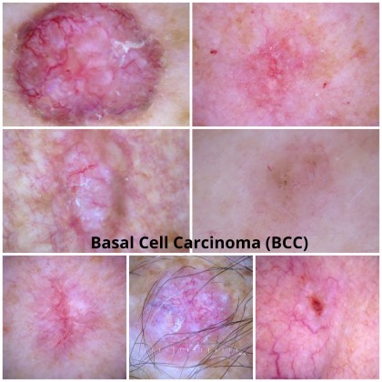 Self Examination for Skin Cancers - Lifestyle Skin Health Clinic